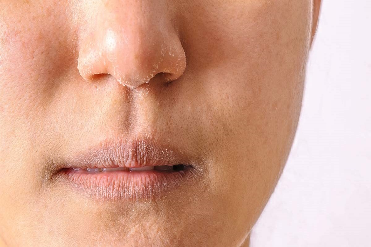 علتهای اصلی خشکی پوست