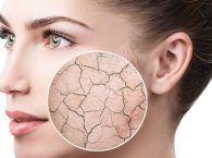 بهترین کرم مرطوب کننده برای پوست خشک