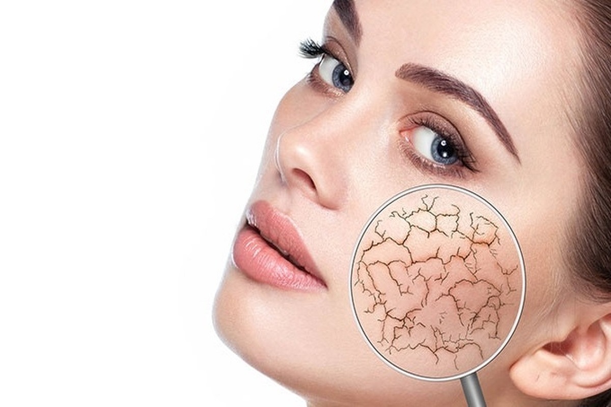 ویژگیهای پوست خشک و حساس